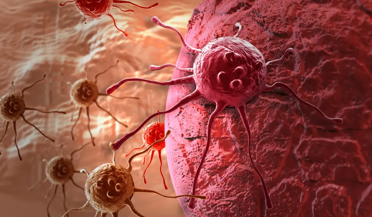 Une Nouvelle Thérapie Élimine les Tumeurs du Cancer du Sein en 11 Jours, Sans Chimiothérapie.