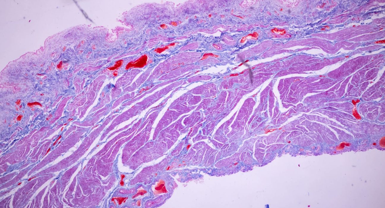Des microplastiques détectés dans le placenta : une menace pour l'hormonal de la grossesse.