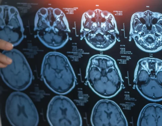 Étude de l'USC: Pollution de l'air quotidienne associée à un amincissement cérébral lié à la maladie d'Alzheimer.